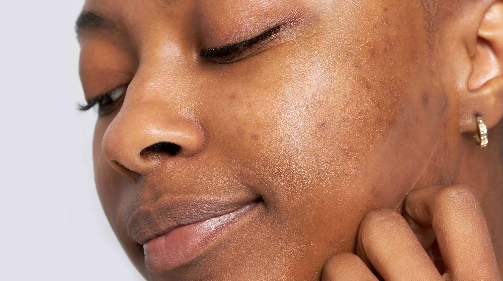 Acne Scars Treatment